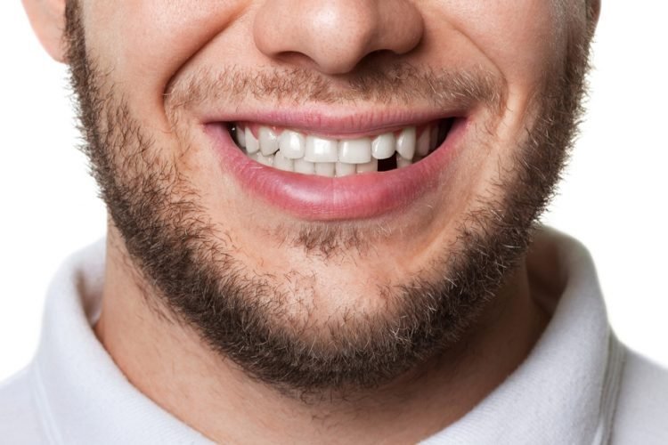 رجل يبتسم مع فقدان أحد الأسنان الأمامية
