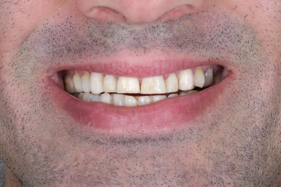ابتسامة الحالة الأولى قبل العلاج