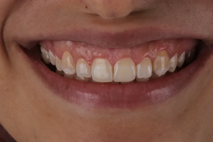 ابتسامة الحالة الثالثة قبل العلاج